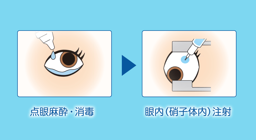 硝子体注射 | 朝来市和田山町の眼科なら『いわわき眼科クリニック』