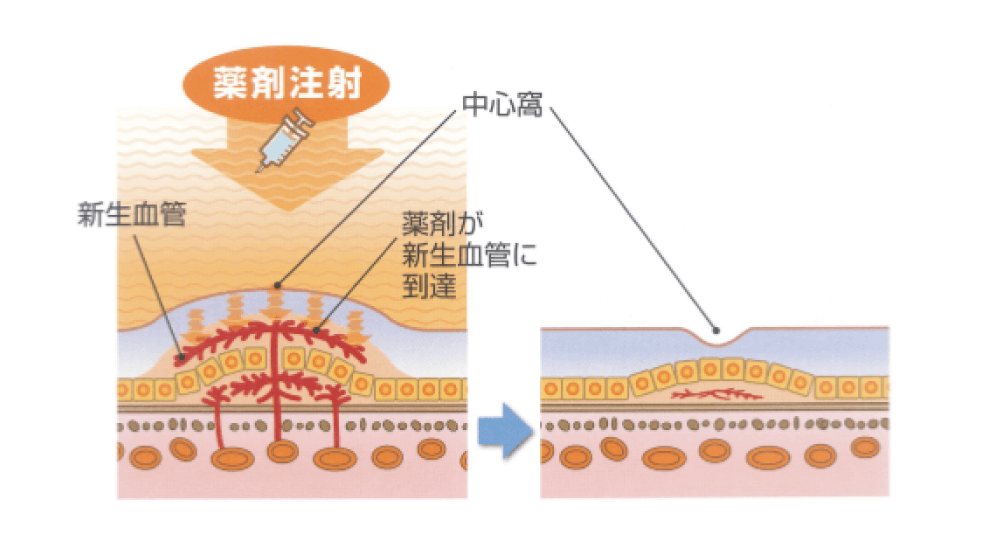 脈絡膜新生血管