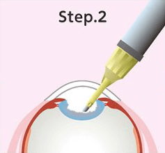 Step.2