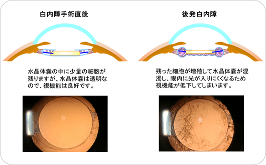 後発白内障について